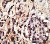IHC analysis of FFPE human breast carcinoma tissue stained with the Beclin antibody