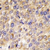 IHC analysis of FFPE human hepatocarcinoma tissue stained with GABARAP antibody