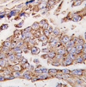 IHC analysis of FFPE human lung carcinoma tissue stained with LAMP1 antibody.