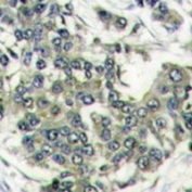 IHC analysis of FFPE human breast carcinoma stained with EIF4E antibody