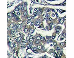 IHC analysis of formalin fixed paraffin embedded human breast carcinoma stained with EIF4E2 antibody~