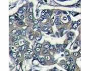 IHC analysis of formalin fixed paraffin embedded human breast carcinoma stained with EIF4E2 antibody