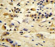IHC analysis of FFPE human breast carcinoma stained with EIF4E2 antibody