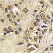 IHC analysis of FFPE human prostate carcinoma tissue stained with Myc antibody