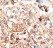 IHC analysis of FFPE human hepatocarcinoma tissue stained with the Osteocalcin antibody