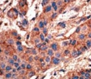 IHC analysis of FFPE human breast carcinoma tissue stained with the ALK3 antibody