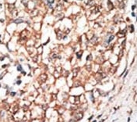 IHC analysis of FFPE human hepatocarcinoma tissue stained with the BMPR1B antibody