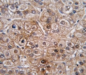 IHC analysis of FFPE human hepatocarcinoma tissue stained with BMPR2 antibody.