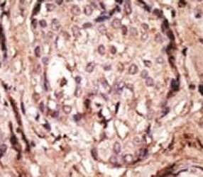 IHC analysis of FFPE human breast cancer tissue stained with the GFAP antibody~