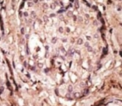 IHC analysis of FFPE human breast cancer tissue stained with the GFAP antibody