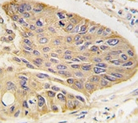 IHC analysis of FFPE human lung carcinoma tissue stained with anti-MAP