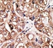 IHC analysis of FFPE human hepatocarcinoma tissue stained with the NeuroD1 antibody