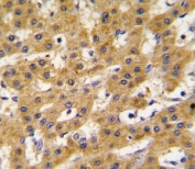 IHC analysis of FFPE human hepatocarcinoma tissue stained with PDX1 antibody