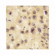 IHC analysis of FFPE human hepatocarcinoma tissue stained with PROX1 antibody