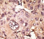 IHC analysis of FFPE human hepatocarcinoma tissue stained with the TAU antibody