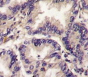 IHC analysis of FFPE human lung carcinoma tissue stained with VEGFC antibody
