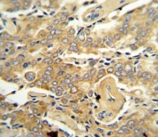 IHC analysis of FFPE human prostate carcinoma stained with VEGF-C antibody