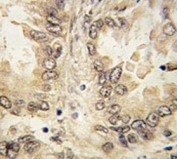 IHC analysis of FFPE human lung carcinoma tissue stained with SOX-2 antibody