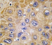 IHC analysis of FFPE human hepatocarcinoma tissue stained with Thy1 antibody