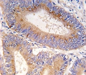 IHC analysis of FFPE human colon carcinoma tissue stained with GDF11 antibody