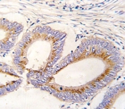 IHC analysis of FFPE human colon carcinoma tissue stained with GDF11 antibody