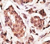 IHC analysis of FFPE human breast carcinoma tissue stained with the PGP9.5 antibody