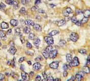 IHC analysis of FFPE human breast carcinoma tissue stained with UCHL3 antibody