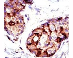 IHC analysis of FFPE human breast carcinoma tissue stained with the TSG101 antibody. ~
