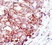 IHC analysis of FFPE human hepatocarcinoma tissue stained with the Mib1 antibody