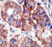 IHC analysis of FFPE human hepatocarcinoma tissue stained with the p62 antibody