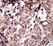 IHC analysis of FFPE human breast carcinoma tissue stained with the RAGE antibody