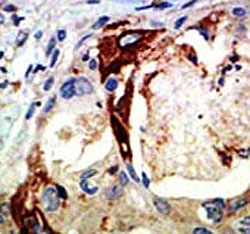 IHC analysis of FFPE human breast carcinoma tissue stained with the Myb antibody~