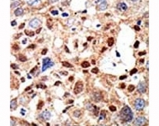 IHC analysis of FFPE human hepatocarcinoma tissue stained with the PML antibody
