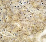IHC analysis of FFPE human prostate carcinoma tissue stained with EZH1 antibody