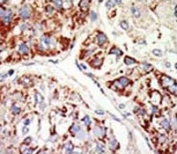 IHC analysis of FFPE human hepatocarcinoma tissue stained with the EZH1 antibody