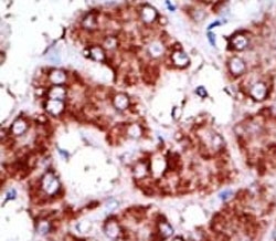 IHC analysis of FFPE human hepatocarcinoma tissue stained with the CPT1B antibody~