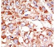 IHC analysis of FFPE human hepatocarcinoma tissue stained with the ACSL3 antibody