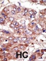 IHC analysis of FFPE human hepatocarcinoma tissue stained with the ACSL6 antibody