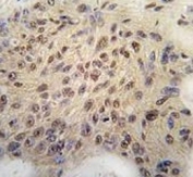 IHC analysis of FFPE human breast carcinoma tissue stained with Cyclin D1 antibody