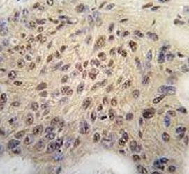 IHC analysis of FFPE human breast carcinoma tissue stained with Cyclin D1 antibody