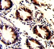 IHC analysis of FFPE human colon carcinoma with KLF4 antibody
