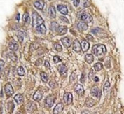 IHC analysis of FFPE human lung carcinoma tissue stained with Aldolase antibody