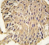 IHC analysis of FFPE human lung carcinoma tissue stained with ALDOA antibody