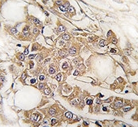 IHC analysis of FFPE human breast carcinoma tissue stained with Vimentin antibody