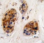 IHC analysis of FFPE human breast carcinoma tissue stained with VIM antibody