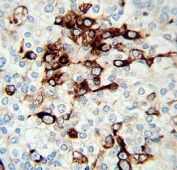 VIM antibody immunohistochemistry analysis in formalin fixed and paraffin embedded human prostate tissue.