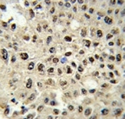 IHC analysis of FFPE human hepatocarcinoma stained with SSB antibody