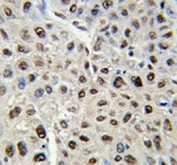 IHC analysis of FFPE human hepatocarcinoma stained with SS-B antibody