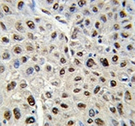 IHC analysis of FFPE human hepatocarcinoma stained with SS-B antibody