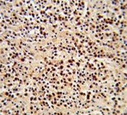 IHC analysis of FFPE human lymphoma stained with LCK antibody